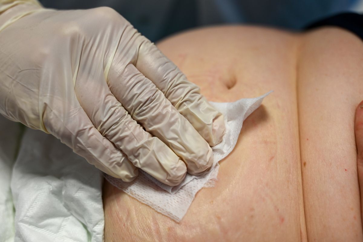 Biopsie pulmonară ghidată CT la un pacient cu cancer de colon: caz explicat
